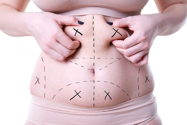 Liposuction