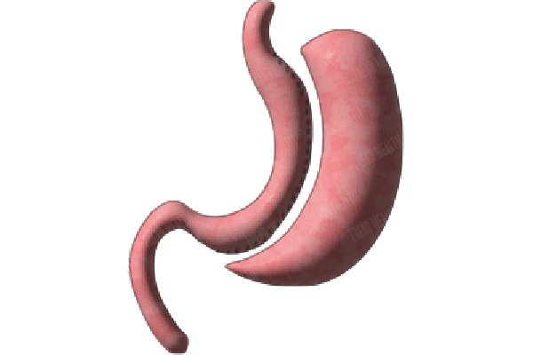 Sleeve Gastrectomy