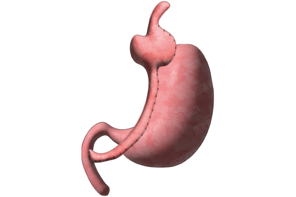 Bypass gastric